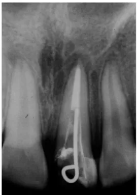 Figure  4.  Definitive  root  canal  treatment  with  the  temporary  intracanal post cemented on tooth 21.