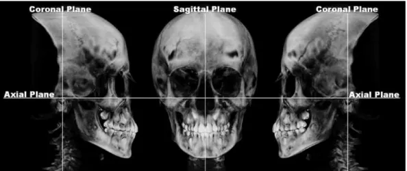 Figure 1. 3D digital head image after orientation by axial, coronal and sagittal planes (Software Dolphin Imaging ®  /Orientation function).