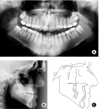 Figure 2. Initial panoramic radiograph (A), lateral cephalometric  radiograph (B) and cephalometric tracings (C).