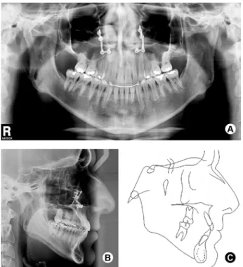 Figure 5. Final panoramic radiograph (A), lateral cephalometric  radiograph (B) and cephalometric tracing (C).
