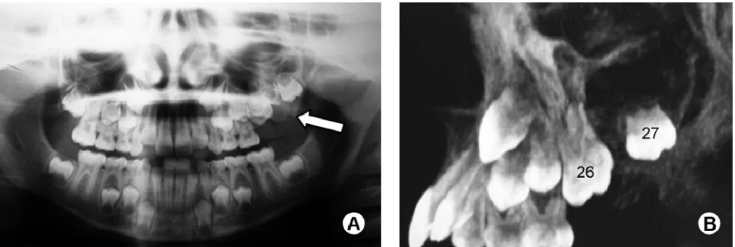 Figure 1. Imaging. A= Initial panoramic film showing a well-circumscribed unilocular radiolucency involving an unerupted permanent  maxillary left first molar and displacement of the maxillary left second molar (arrow)