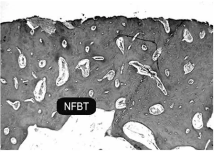 Figure 2. Image of bone cavity well delimited by the remaining  bone  (RM),  characterized  by  mature  bone  tissue  (BT)  and  reduced intertrabecular spaces with concentric formation