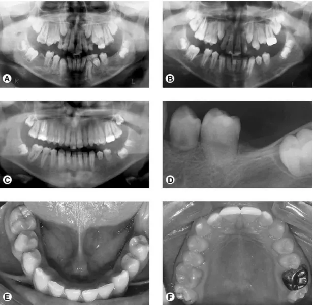 Figure 1. Panel of clinical and radiographic images of the case; A= Panoramic radiograph showing missing teeth 36 and 46, shortening  of root length in teeth 34, 35 and 37 in compared to the contralateral teeth, presence of extensive carious lesions in tee