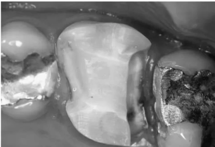 Figure 1. A periapical radiograph was obtained to identify the  proximal space loss between teeth 26 and 27.
