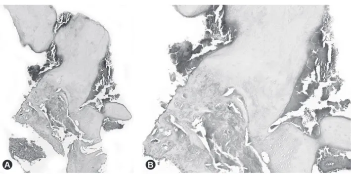 Figure 1. Clinical aspect with tissue overlying occlusal surface  of the mandibular right first molar.