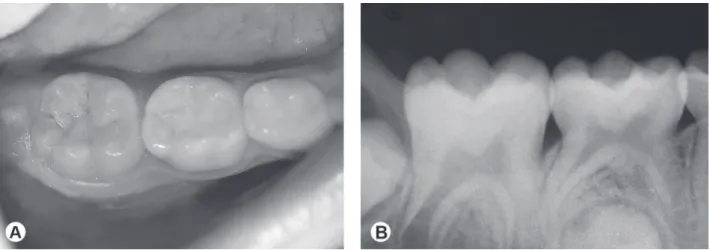 Figure 3. A: Clinical aspect after 6 months showing the mandibular first molar erupted