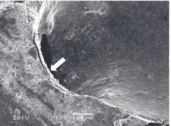 Figure 2. Mixed failure in the CHX group. Note the sealer attached  to the root canal wall (arrow).