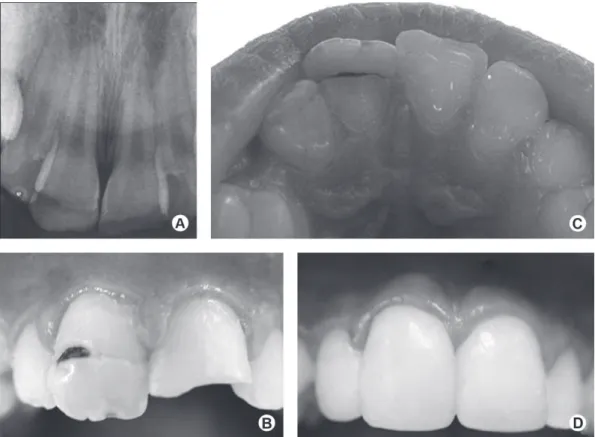 Figure 1. Case 1. A: Periapical radiograph of the permanent maxillary central incisors, showing the presence of crown dilaceration