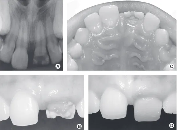 Figure 2. Case 2. A: Periapical radiograph of the permanent maxillary left central incisor, showing the presence of crown dilaceration