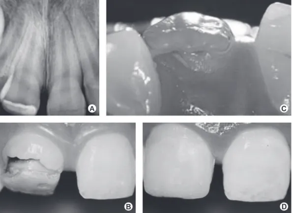 Figure 3. Case 3. A: Periapical radiograph of the permanent maxillary right central incisor showing crown dilaceration