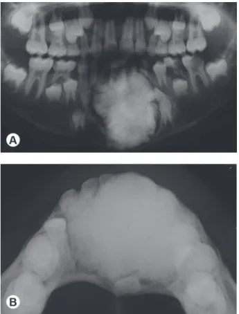 Figure 2. Occlusal radiograph and panoramic views showing two  postoperative moments: postoperative appearance of the surgical  area  immediately  after  lesion  resection  (A)  and  postoperative  appearance of the surgical area after 3 years of follow-up