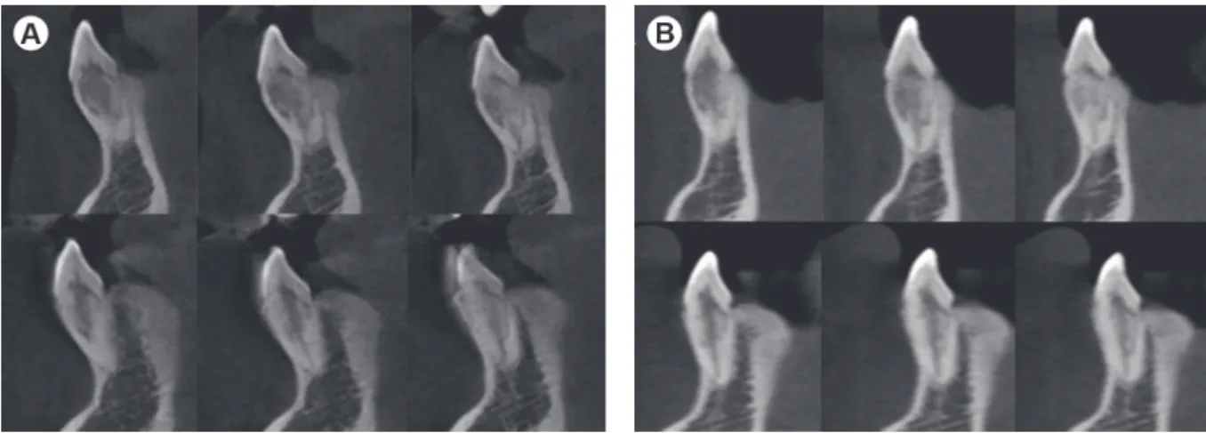 Figure 2. Case 1. Comparison by cone beam computed tomography (CBCT) showed the same condition over time, without evolution