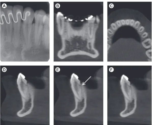Figure 3. Case 2. A: Periapical radiograph demonstrating the cloudy radiolucency of the root canal in the coronal and middle thirds of  the root