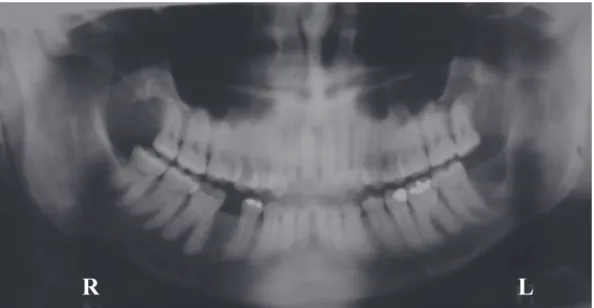 Figure 4. Panoramic radiograph 8 months after surgery revealing good bone healing.