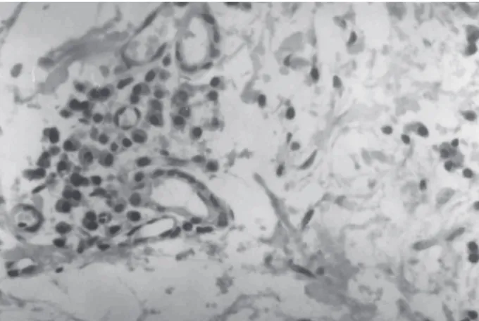 Figure  1.  Clusters  of  CD25+  cells  distant  from  epithelium  in  chronic gingivitis.