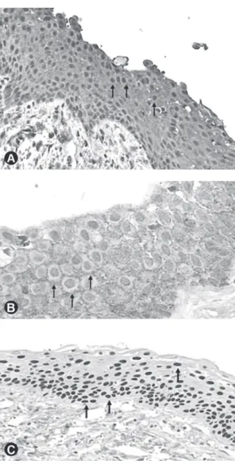 Figure 1. Radicular cyst. A: High and strong expression intensity  of Notch-1 in the epithelial lining (×100); B: High and strong  staining intensity of EGFR in the cystic epithelial lining (×200); 