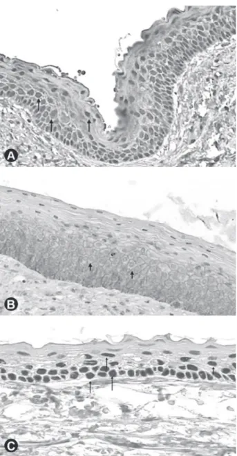 Figure 2. Dentigerous cyst. A: High and strong expression intensity  of  Notch-1  in  the  cystic  epithelial  lining  (×100);  B:  High  and  strong staining intensity of EGFR in the epithelial lining (×100); 