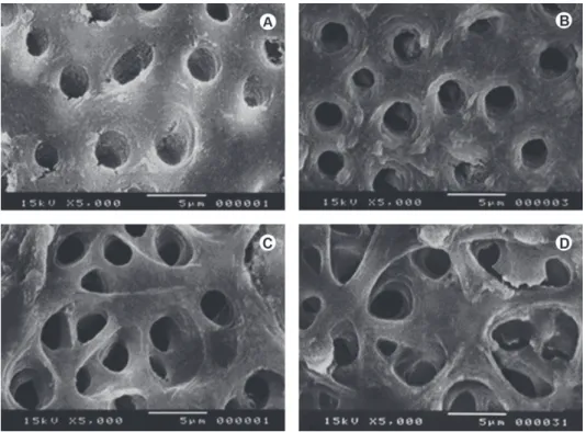 Figure 2. Composite figure of SEM micrographs. A: Slight erosive effect on the peritubular and tubular dentin (G3 at ×5,000)