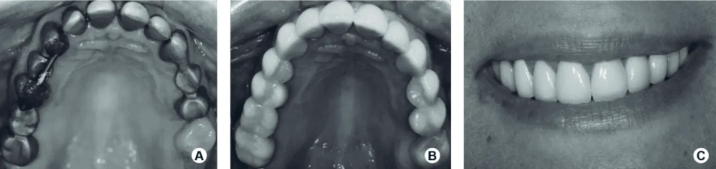 Figure 3. Clinical images showing try of metallic frameworks (A) and occlusal view of metal-ceramic restorations after cementation  (B) and the patient’s smile after completion of the treatment (C).