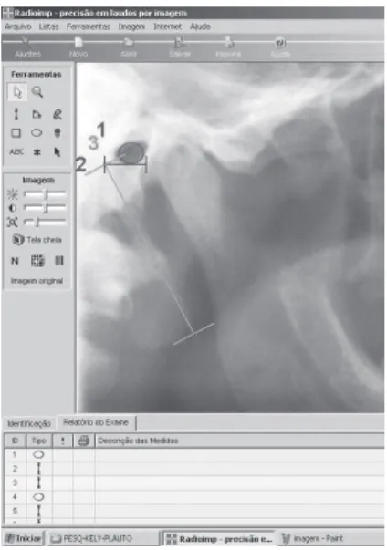 Figure 3. Measurement of the length of the styloid process on  cephalometric radiograph.