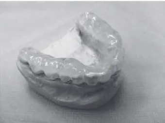 Figure 1. Extraoral picture of the anterior repositioning splint, in  which the relieve elements are made of light-cured resin.