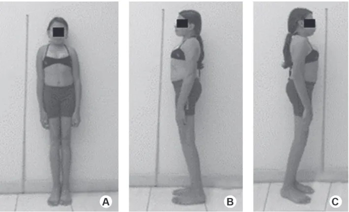 Figure 1. A 16 year-old youngster with ML III, exhibiting long biotype, short stature (1.5 m), protruded thorax and joint stiffness (A-B).