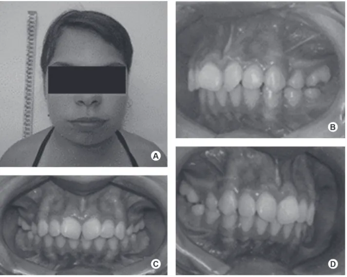 Figure 2. Extraoral examination demonstrating short neck, slightly coarse face, and good lip seal (A)