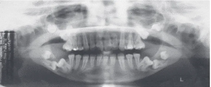 Figure 3. Panoramic radiograph showing radiolucent images associated with impacted teeth.