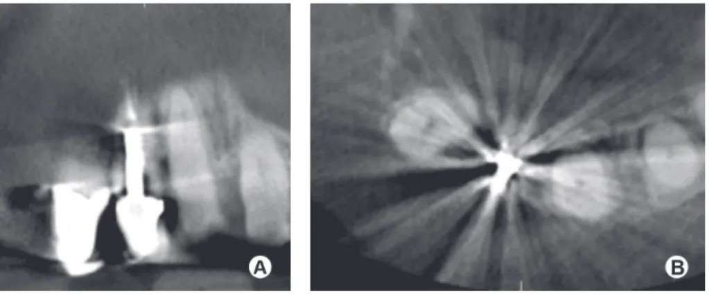 Figure 1. (a,b) Coronal (a) and axial (b) CBCT slices through a maxillary left central incisor tooth restored with a post-retained crown