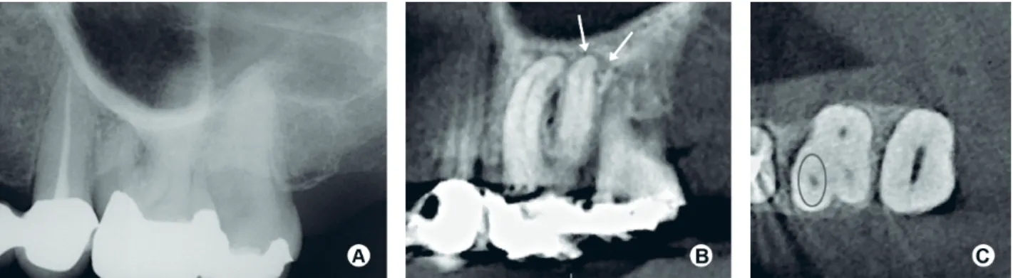 Figure 2. (a) Periapical radiograph of a symptomatic maxillary left first molar tooth