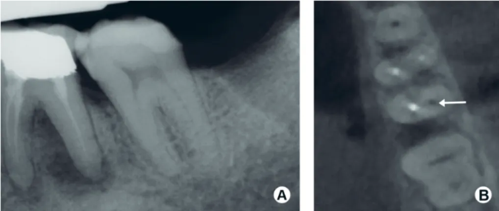 Figure 7. (a) Periapical radiograph of a mandibular left first molar tooth with a 10º horizontal shift in the angle of the X-ray tube head