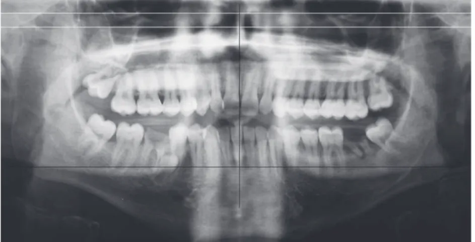 Figure 2. Cone beam computed tomography 3D reconstruction showing the relationship  between the enlarged coronoid process and the zygomatic arch