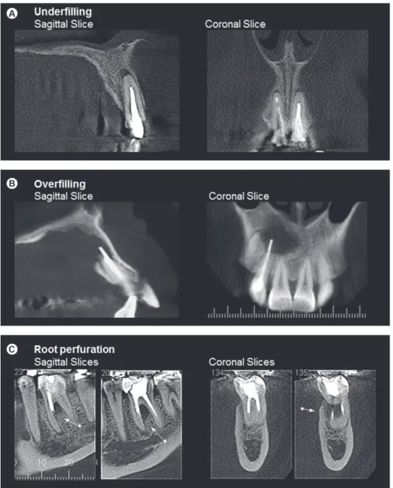Figure 1. Operative procedural errors in endodontically treated teeth. A: Sagital and coronal slices of maxillary central incisor with  underfilling showing periapical radiolucency, B: Sagittal and coronal slices of maxillary lateral incisor with overfilli