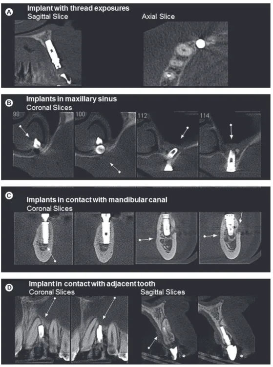 Figure 2. Operative procedural errors in dental implants. A: Sagittal and axial slices of dental implant in maxillary anterior region with  thread exposures in buccal and palatal faces, B: Coronal slices of dental implant in posterior maxillary region with