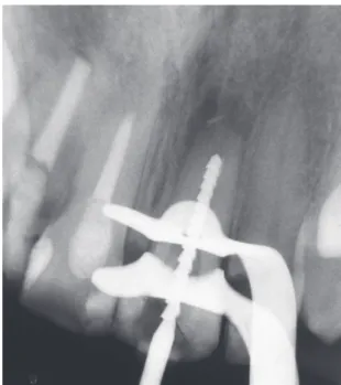 Figure 2. A #140 Hedström file was secured in place with the  use of apex locators, but the estimation of the working length  was inconclusive.
