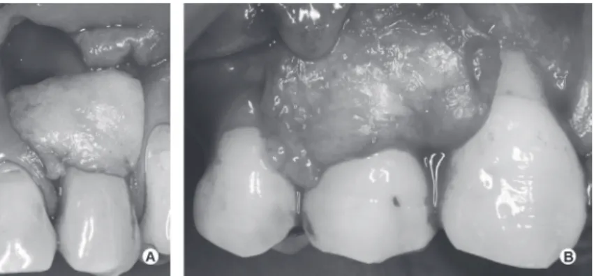 Figure 4. The graft was sutured to the receptor site in the Control (A) and Test  (B) groups using absorbable sling sutures.