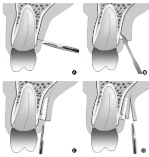 Figure 1. Surgery at the recipient site. A: Preoperative multiple gingival recession. B: Oblique incisions