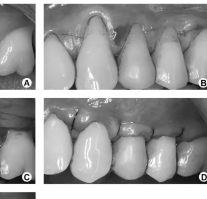 Figure 3. Harvesting of the palatal donor site. A: Incision perpendicular  to the palatal tissue until reaching the bone in a horizontal direction