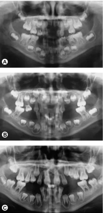 Figure 3. Panoramic x-ray showing generalized extensive alveolar bone  loss. A: Child was 5 years old