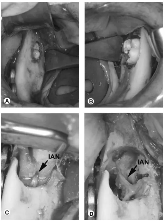 Figure 2. The posterior limits of the surgical approach. A: Right side is showing the molar partially retained