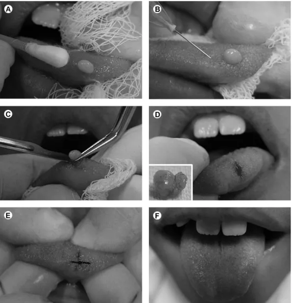 Figure 2 .  Surgical enucleation of a fibroma. A: Application of a topical anesthetic paste