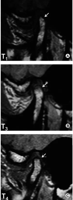 Figure 3. Patient 19 - MRIs of right TMJ. There was a significant change in  condyle morphology (degenerative bone disease) at T 1  (A) and it improved  with treatment at T 3  (B), remaining stable when evaluated at T 4  (C).