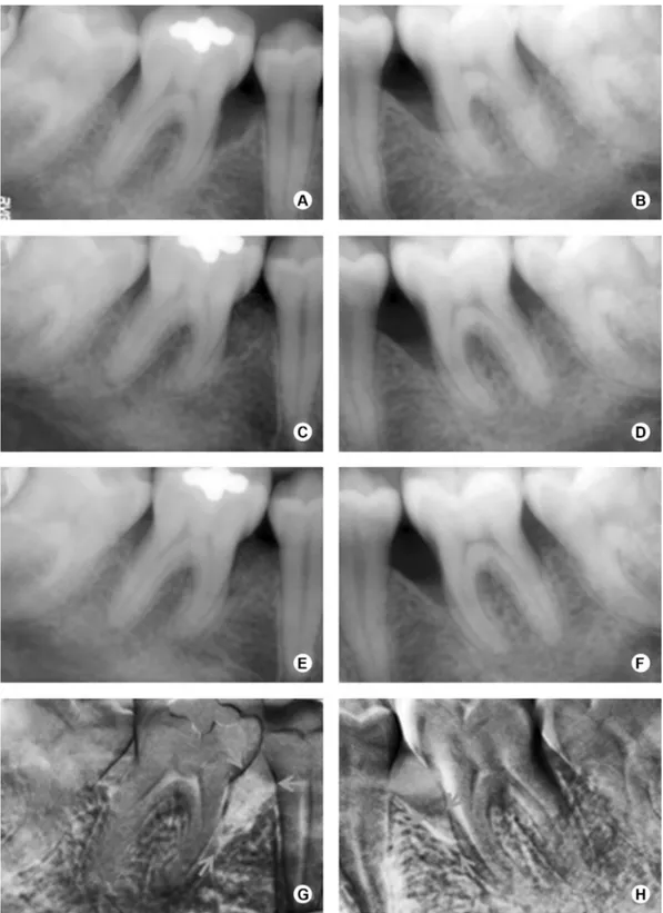 Figure 1. A,B: Baseline radiographs; C: 3-month radiograph in ABM/P-15 group; D: 3-month radiograph in GTR group; E: 6-month radiograph in  ABM/P-15 group; F: 6-month radiograph in GTR group; G: Subtraction radiograph in ABM/P-15 group, with a brighter are