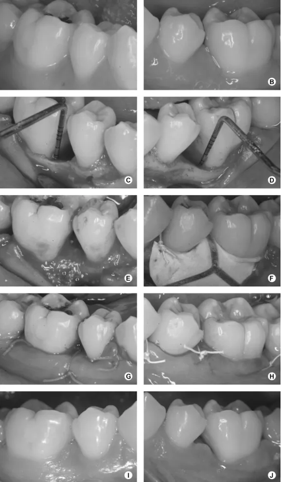 Figure 2. A,B: Baseline view; C, D: Intrabony defects; E: ABM/P-15 in place; F: Membrane positioned and sutured