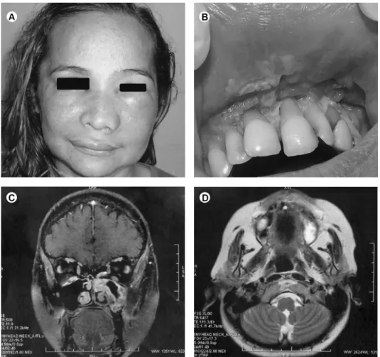 Figure 1. A: Erythematous facial asymmetry with elevation of the nasal wing and inferior eyelid