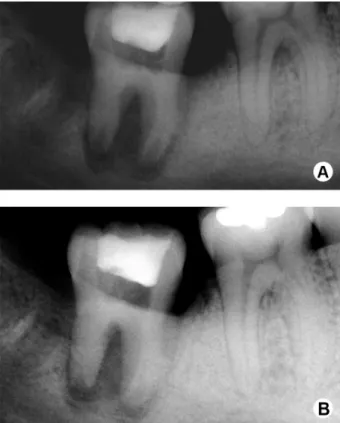 Figure 2. A: Root canals not properly filled with calcium hydroxide  paste. B: Autotransplanted tooth after a second application of calcium  hydroxide as intracanal dressing.