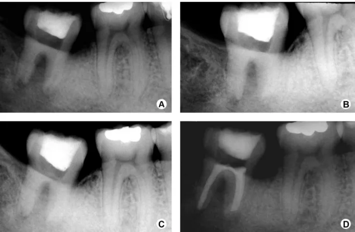 Figure 3. Radiographs taken after the calcium hydroxide was replaced with fresh material