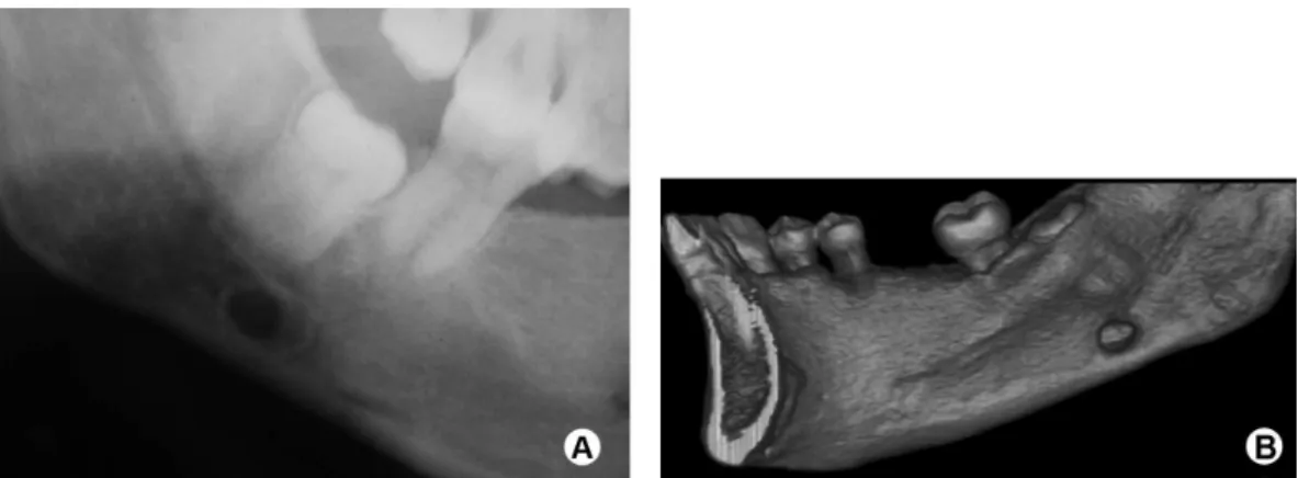 Figure 2. A: LCMBD on the right posterior area of the mandible (detail of a panoramic radiograph)
