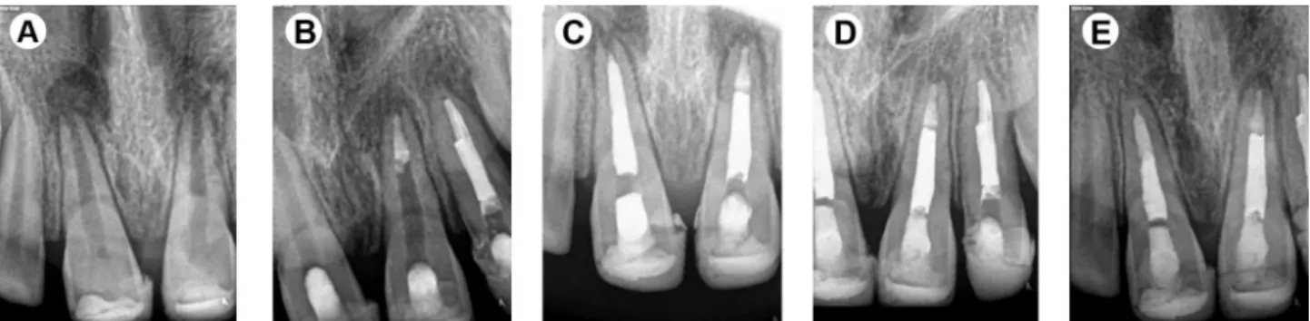 Figure 1. Case 1 - treatment sequence and recall evaluations. A: Preoperative radiograph demonstrating apparent radiolucency and open apex on both  central incisors