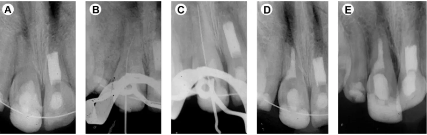 Figure 2. Case 2 - Treatment sequence and recall evaluations. A: preoperative radiograph demonstrating apparent radiolucency and open apex on  tooth maxillary right central incisor